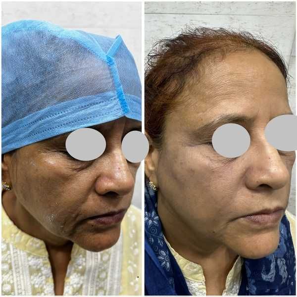 1 ml dermal filler before and after result at Truederm Jaipur