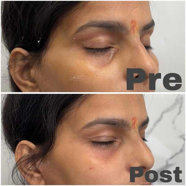 Dark circle treatment before and after result at Truederm Jaipur