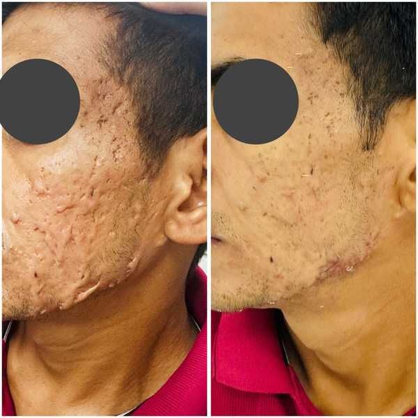 Acne scar treatment before and after result at Truederm Jaipur