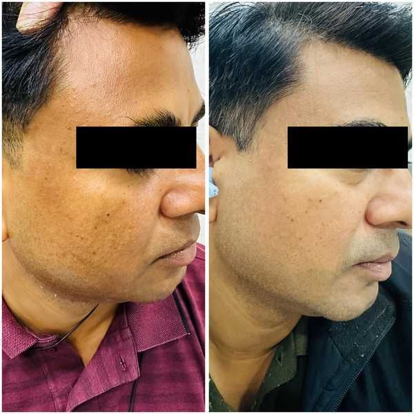 Glutathione skin brightening drip therapy result at Truederm Jaipur