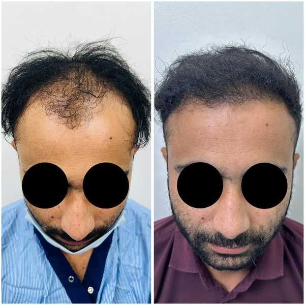 Hair transplant before and after result at Truederm Jaipur