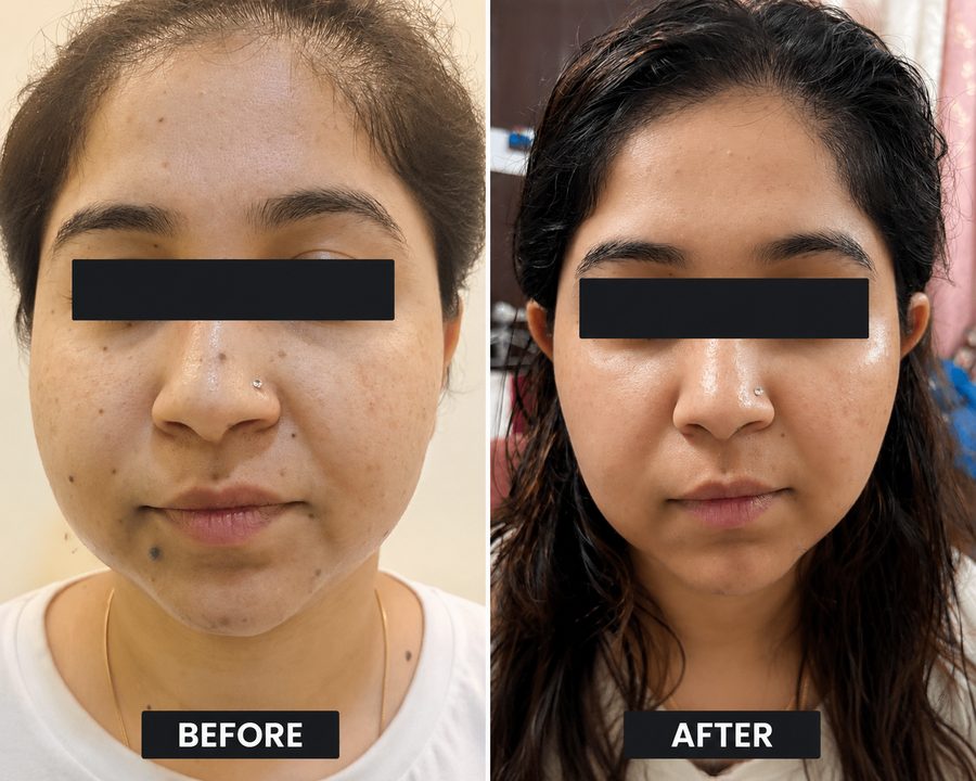 Mole removal before and after result at Truederm Jaipur